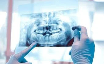 Dental Implant in Turkey 1
