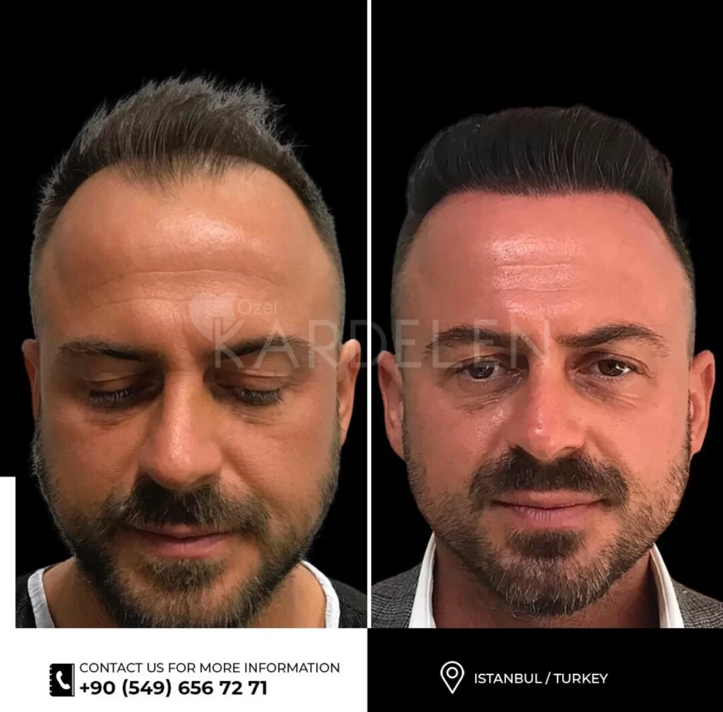 hair transplant before after 1