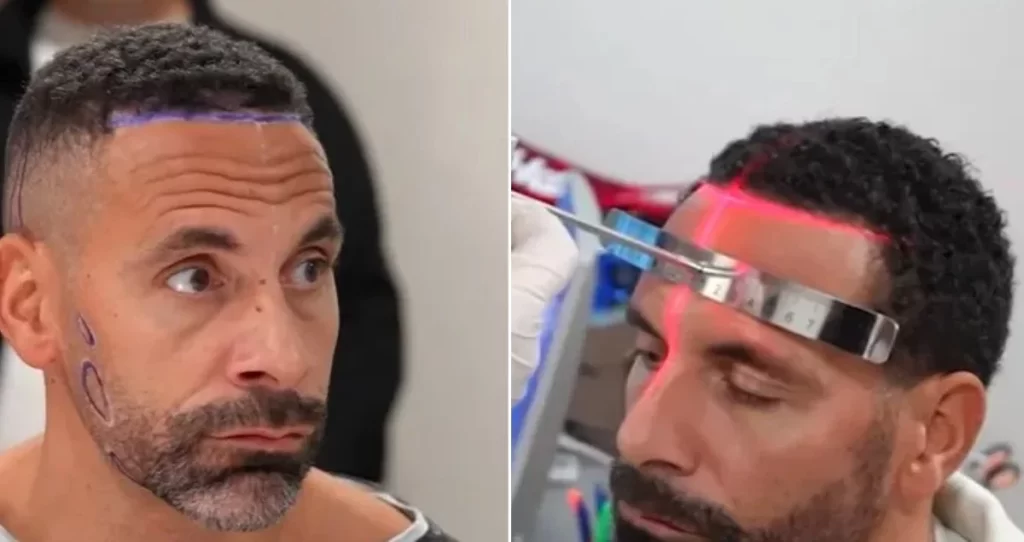 Did Rio Ferdinand Get a Hair Transplant?
