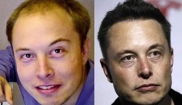 Elon Musk Hair Transplant Before and After
