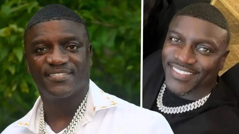 Akon Hair Transplant