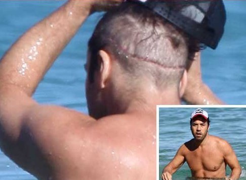 Jeremy Piven Hair Transplant Scar