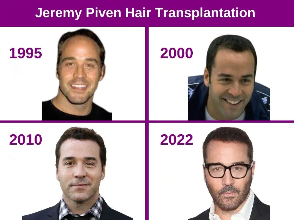 Jeremy Piven Hair Transplant 1